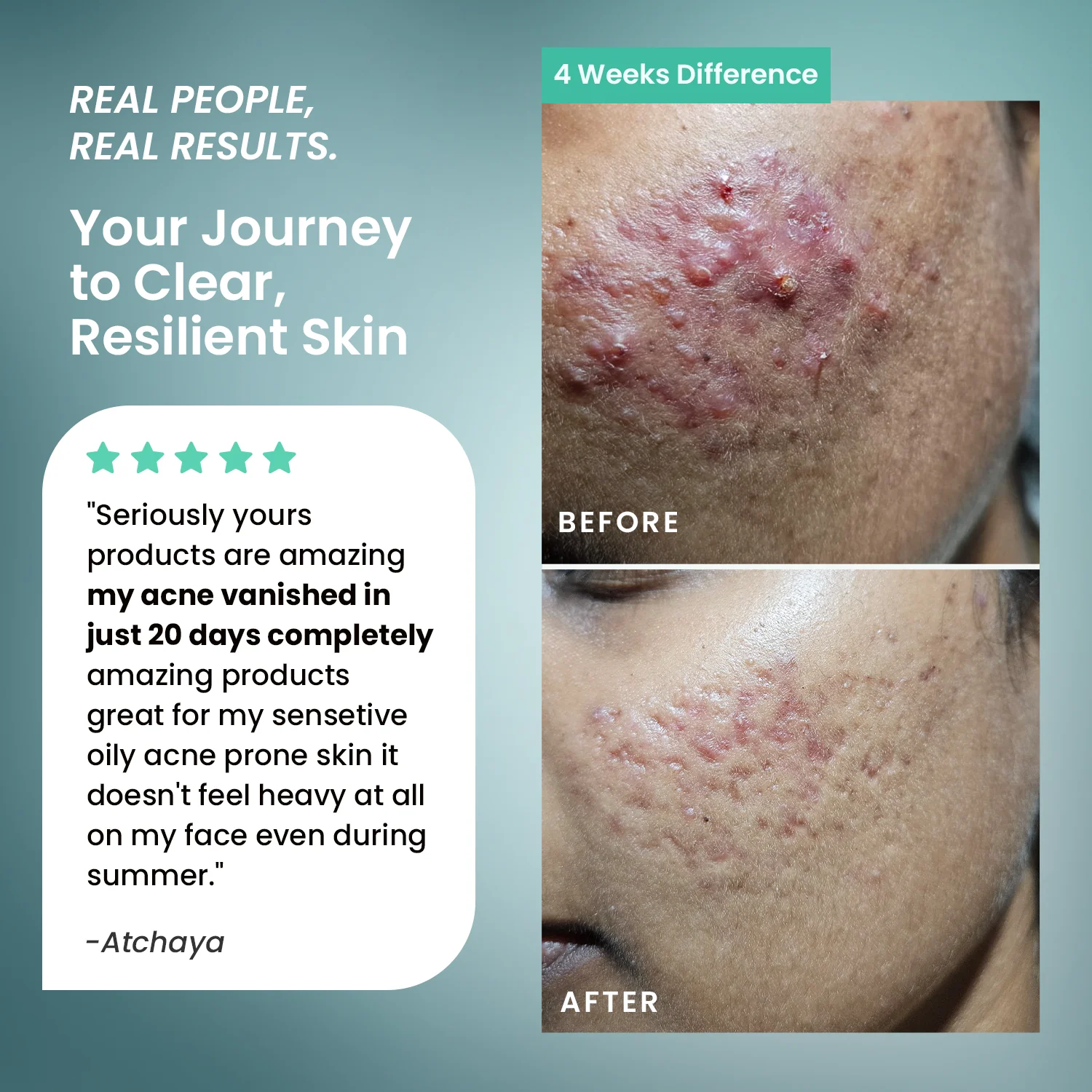 Acne Care Combo Kit - Image 5
