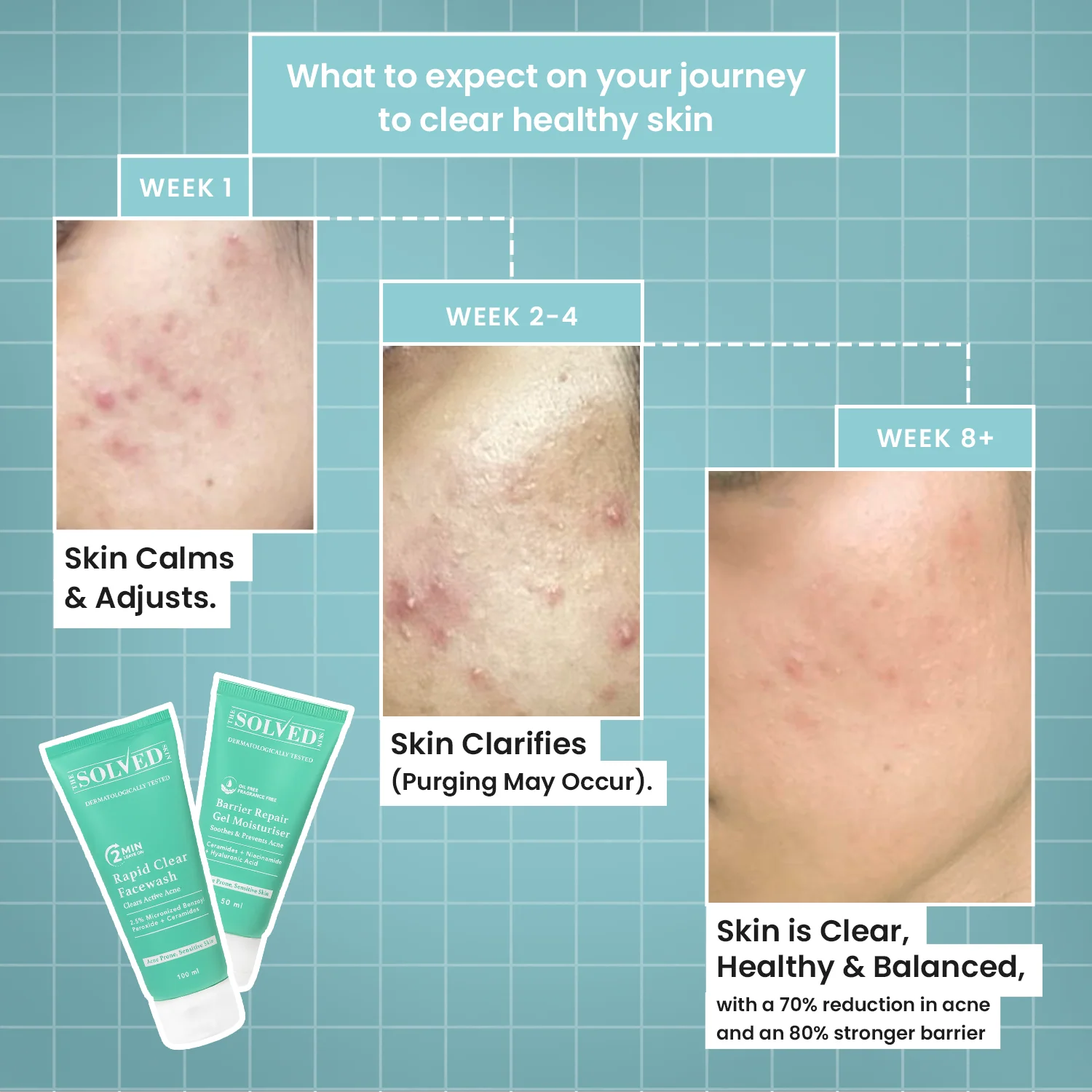 Acne Care Combo Kit - Image 7
